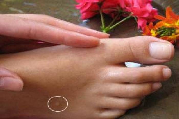इन आसान उपायों से मस्से हो जाएंगे गायब, आलू और प्याज भी आते हैं काम