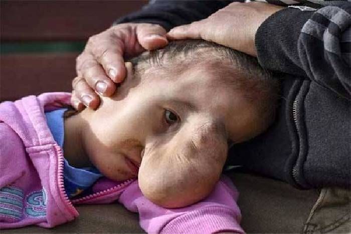 surgery changed life अजीबोगरीब बीमारी की शिकार थी, सर्जरी ने बदल दी जिंदगी