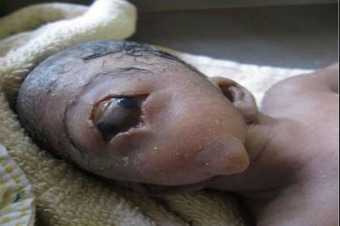 Women gave birth to a child like a monster महिला ने दिया विचित्र बच्चे को जन्म, जिसकी दोनों आंखें आपस में जुड़ी हुई थीं